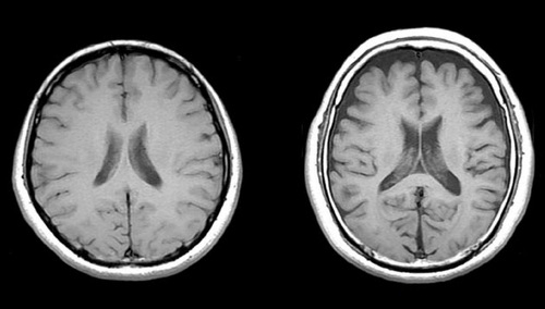アルコール依存症で脳が萎縮する?前頭葉に与える …